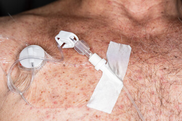 Tube for intravenous fluids injections to implantable port for chemotherapy
