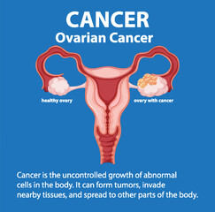 Comparing Normal and Cancerous Ovaries in Medical Anatomy Infographic