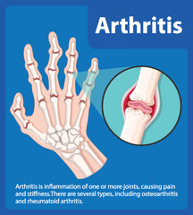 Science Education of Human Anatomy: Arthritis Stages on Hand Infographic
