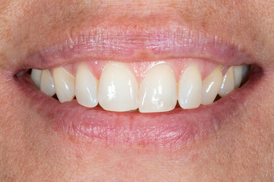 Feminine smile with gleaming white teeth