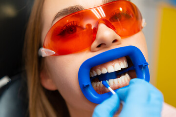Teeth whitening procedure for young beautiful woman in orange protective goggles. 