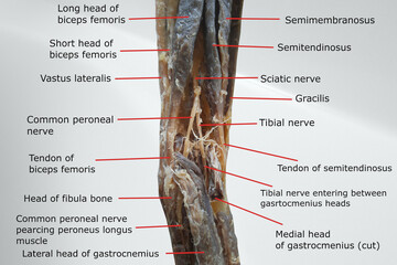 anatomy of popliteal region with the distal portion of back of thigh and proximal portion of back of leg. picture containing related muscles, nerves, tendon and fossa. - obrazy, fototapety, plakaty