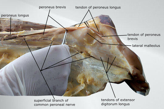anatomy of lateral compartment of leg i.e. peroneal compartment. contains related muscles, tendon, bony prominence and nerve