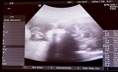 Ultrasonography on the uterus of a pregnant woman showing a healthy fetus, maternal ultrasound...