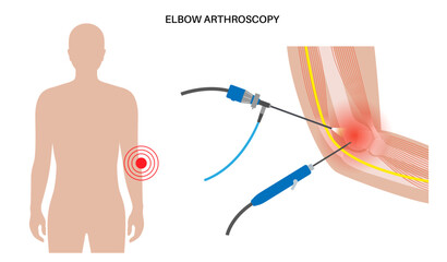 Elbow arthroscopy surgery