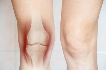 Female legs with x-ray of the patella with overlay effect, knee pain, knee pain, pain