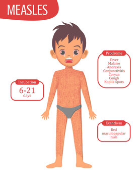 Boy with Measles Rash Viral Exanthem Series