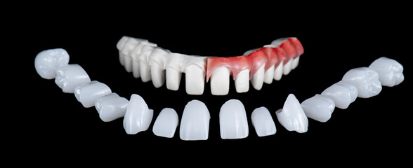 max natural look crowns on implants