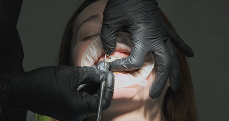 Orthodontist snaps off the locks on the braces to remove them from the patient's teeth.