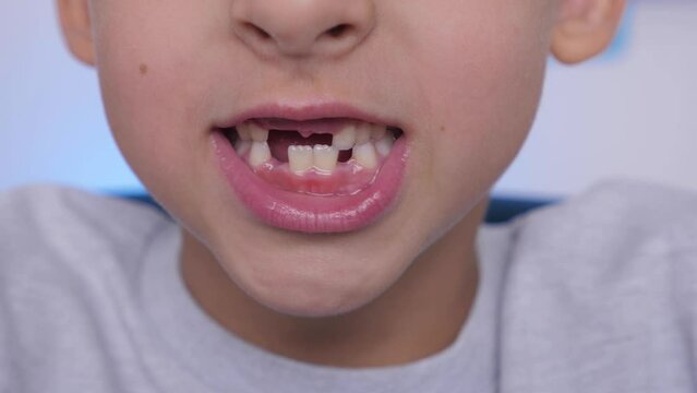 Close-up mouth child has lost one milk teeth. Replacement of permanent changing teeth, toothless smile and hole in the gum. Children dentistry concept. the boy smiles at the camera