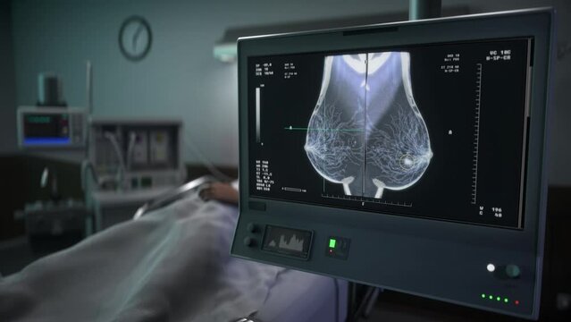 X-ray Scan Discovers Cancer Cells Affecting Tissues Of Patient's Breast. Cancer Disease Scan For Patient Treatment Plan. Cancer Tumor Analysis. Screening Scan. Examining Patient With Medical Equipment