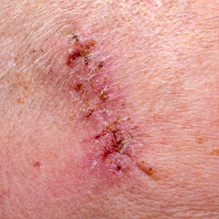 Wound after removal of threads after surgery