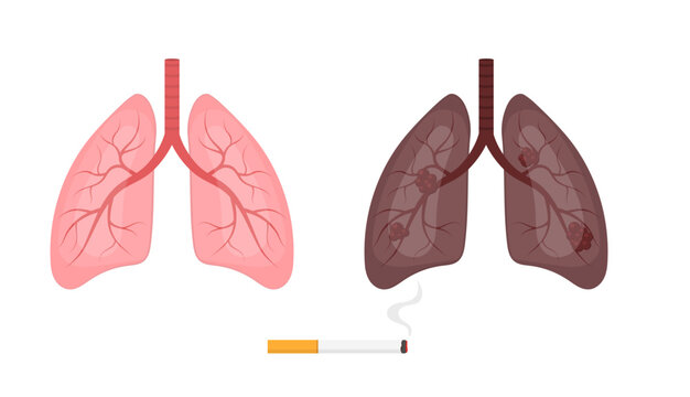 Healthy lungs and smokers lungs. Cigarette cancer concept. Pulmonary diseases.