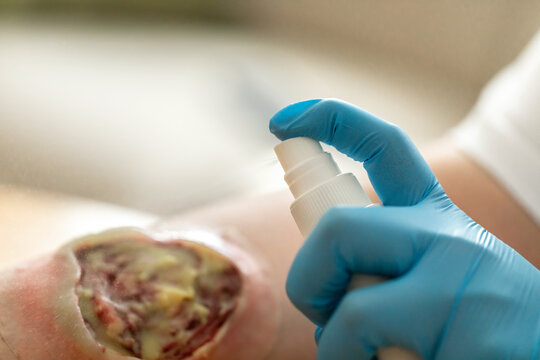 Wound care concept: Symbolizing change of dressing and cleaning and debridement of a wound with a realistic fake wound