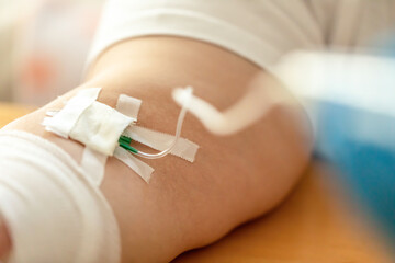 Close-up of a infusion on a patients arm