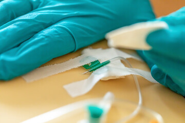 Infusion management: Close-up of a butterfly cannula