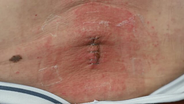 Stitched wound in the lumbar region of the patient who had lumbar microdiscectomy
