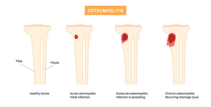 Tibia bone osteomyelitis