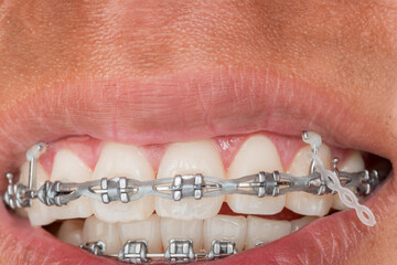 the rubber ties, rubber bands, or elastics that hold the archwire to the brackets on braces are...