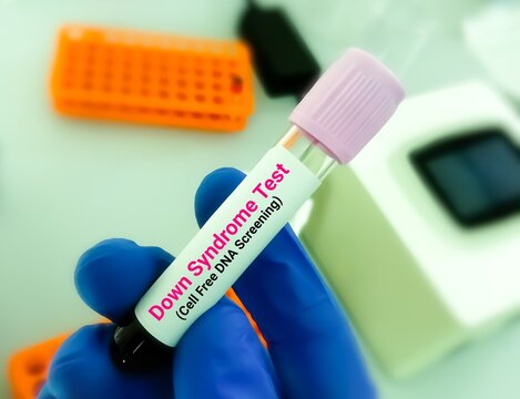 Blood Sample For Prenatal Cell Free DNA Screening Test During Pregnancy, To Diagnose Down Syndrome.