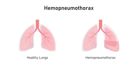 Hemopneumothorax Lung Disease Concept Design. Vector Illustration.