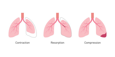 Atelectasis Lung Disease Concept Design. Vector Illustration.