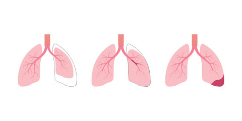 Atelectasis Lung Disease Concept Design. Vector Illustration.