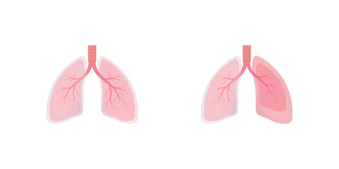 Hemothorax Lung Disease Concept Design. Vector Illustration.