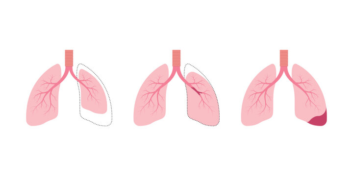 Atelectasis Lung Disease Concept Design. Vector Illustration.