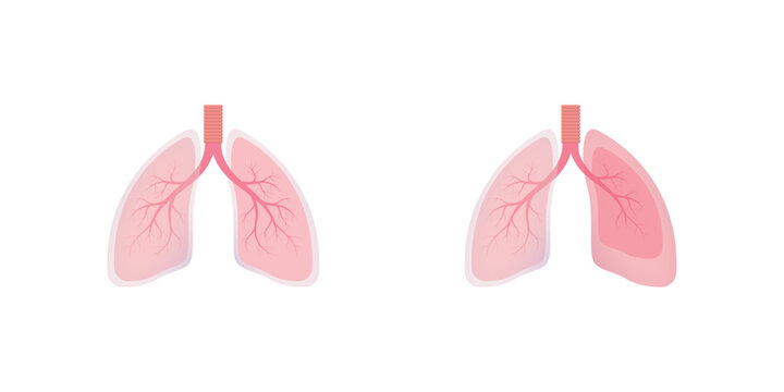 Hemothorax Lung Disease Concept Design. Vector Illustration.