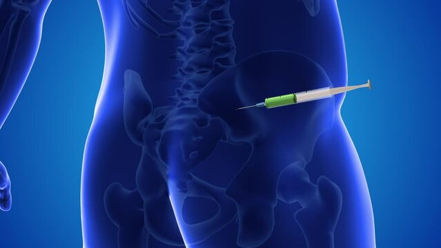 Injecting stem cells into a human pelvis