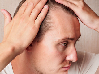 Bald patches on the head of a man alopecia hair growth hair care close-up