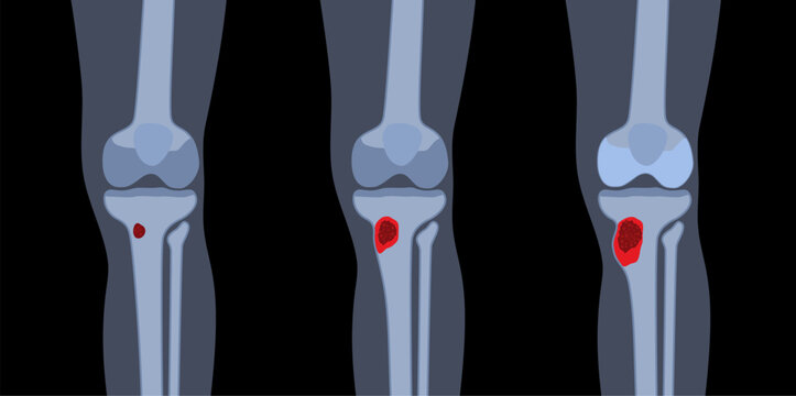 Tibia bone osteomyelitis