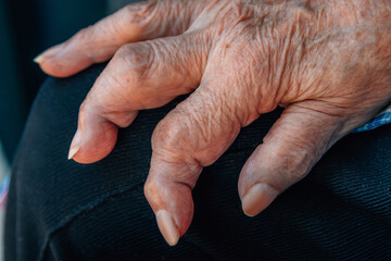 hands of a 90s woman with osteoarthritis