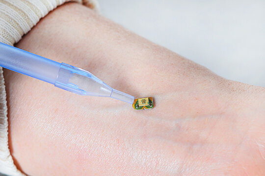 A small microcircuit lies on the wrist of a human hand, is pressed by a medical instrument next to a vein, Health Modification Control by Nanotechnology. Chip installation process. Health correction.