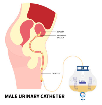 Urology urinary catheters Catheterisation for the E coli bacteria infection of enlarged bladder gland cancer pain with urge leak urinating bag the anatomy medical