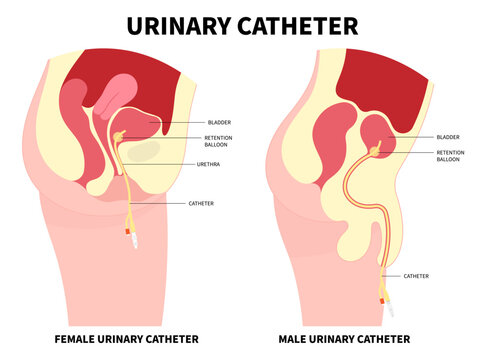Urinary Catheters for the E coli bacteria infection of bladder with Catheterisation in urology urge leak urinating bag anatomy medical and pain gland or Enlarged cancer