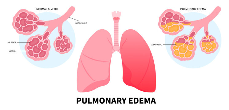 Lung pulmonary cancer common cold with RSV and COPD flu distress virus in Human chest pain the COVID Coronavirus or edema sepsis Xray for oxygen breath tract medical