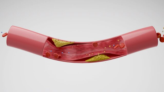 Hyperlipidemia or high cholesterol in blood vessel, Blood cell flowing in artery and blocked by fat, white background 3D rendering.