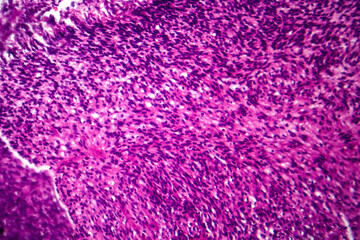 Fibrosarcoma, light micrograph