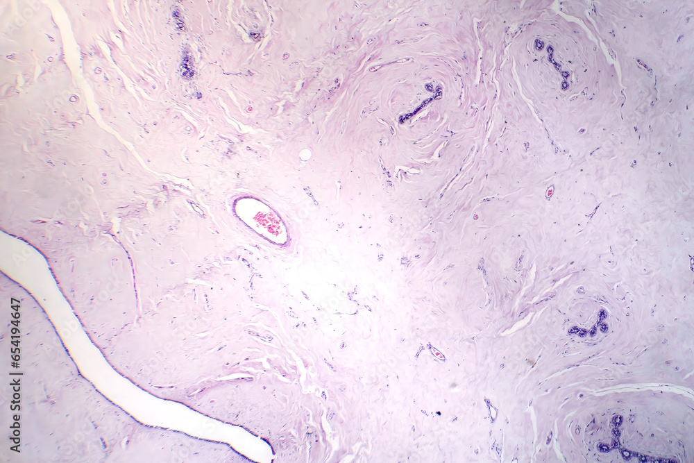 Poster Ffibroadenoma, light micrograph