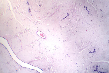 Ffibroadenoma, light micrograph