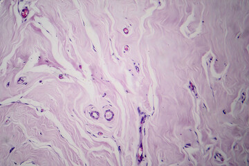 Ffibroadenoma, light micrograph