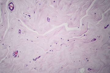 Ffibroadenoma, light micrograph