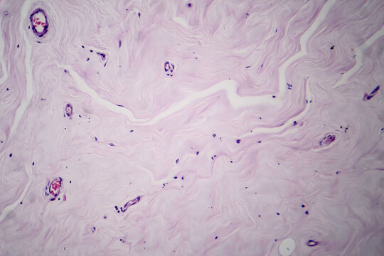 Ffibroadenoma, light micrograph