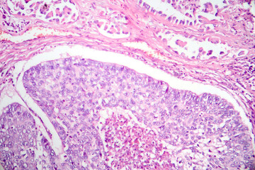Lung adenocarcinoma, light micrograph