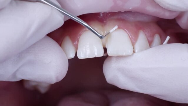 Dentist applying retraction cord between patient's teeth and gingiva