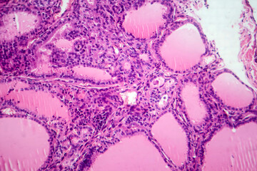 Toxic goiter, light micrograph