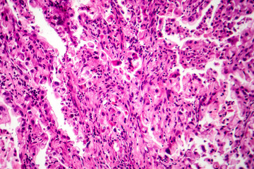 Lung cancer tissue, light micrograph