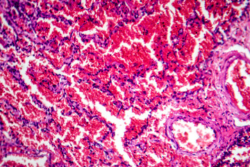 Acute pulmonary hemorrhage, light micrograph